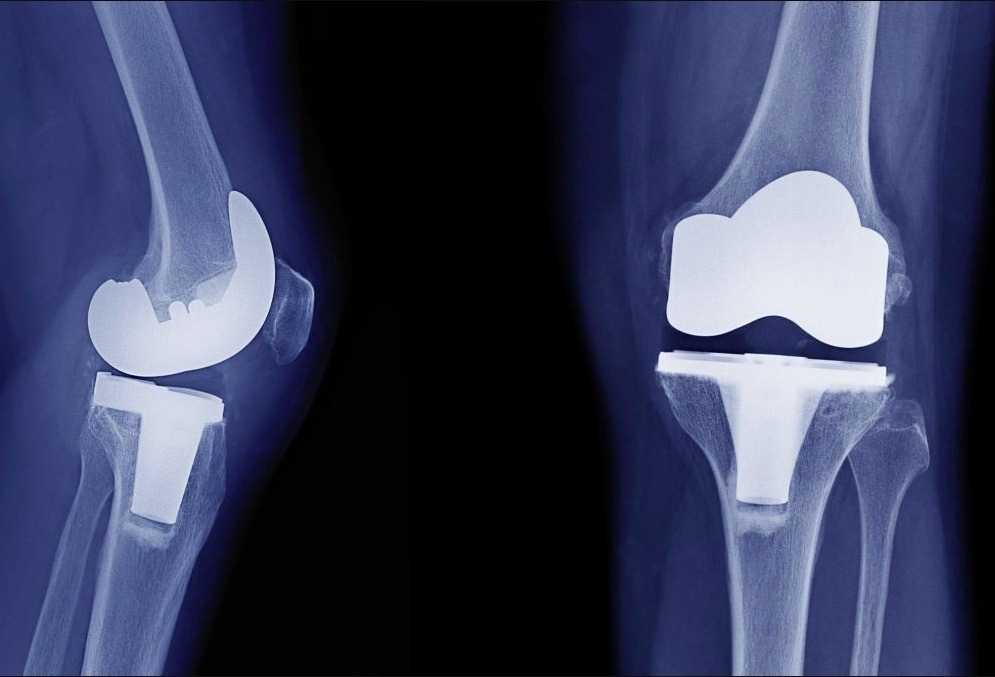 Hip Replacement Aids and equipment to assist recovery and activity